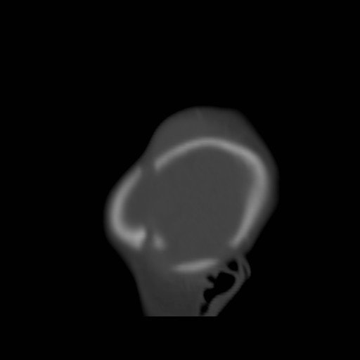 File:Bilateral cephalohematomas and subdural hematomas (Radiopaedia 26778-26929 Sagittal bone window 3).jpg
