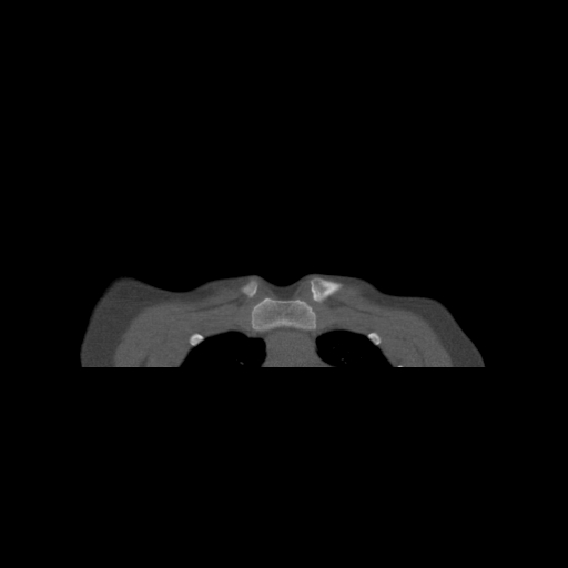 Bilateral chronic posterior shoulder dislocation (Radiopaedia 39213-41452 Coronal bone window 2).jpg