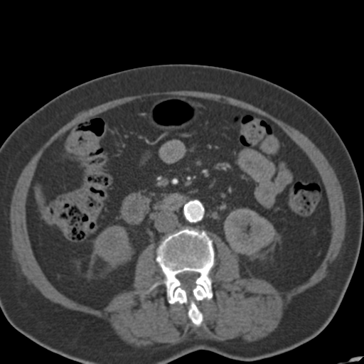 File:Bilateral delayed nephrogram from renal artery stenosis (Radiopaedia 47681-52362 A 29).png