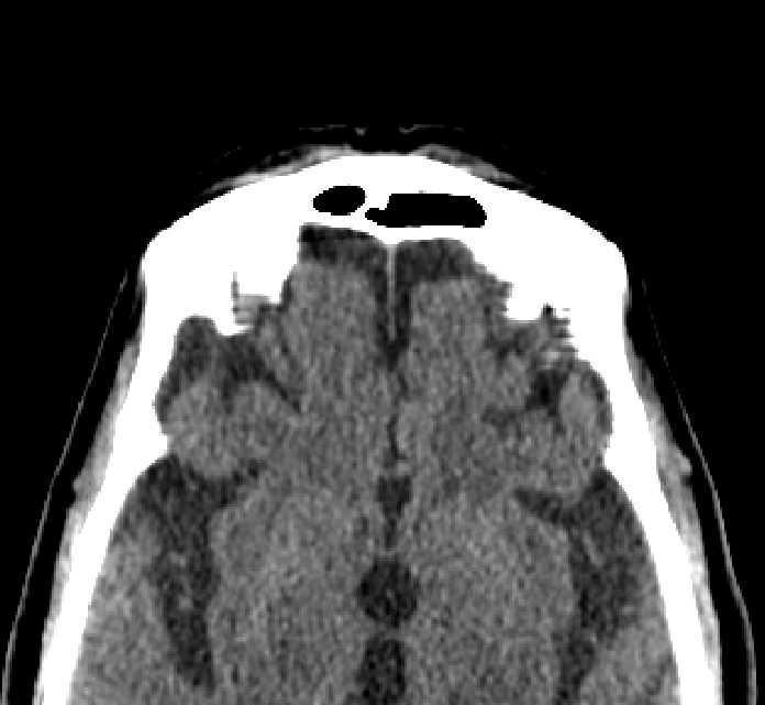 Bilateral ectopia lentis (Radiopaedia 89889-107013 Axial non-contrast 1).jpg