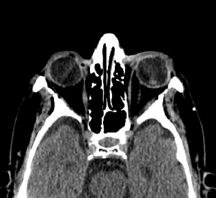 Bilateral ectopia lentis (Radiopaedia 89889-107013 Axial non-contrast 47).jpg
