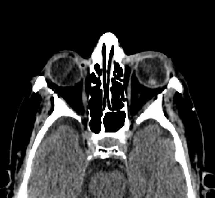 Bilateral ectopia lentis (Radiopaedia 89889-107013 Axial non-contrast 48).jpg