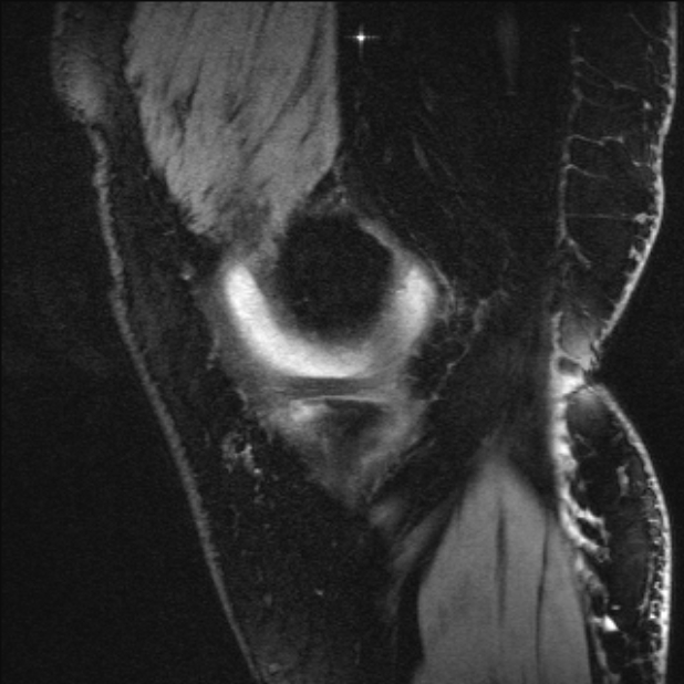 Bilateral focal pigmented villonodular synovitis (Radiopaedia 67643-77073 Sagittal T1 vibe 54).jpg