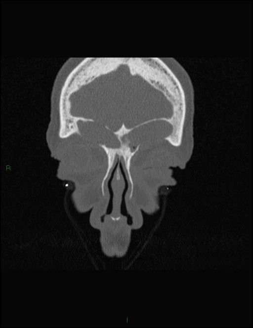 Bilateral frontal mucoceles (Radiopaedia 82352-96454 Coronal 67).jpg