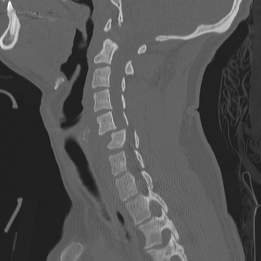 Bilateral locked facets (Radiopaedia 33850-35016 Sagittal bone window 17).png
