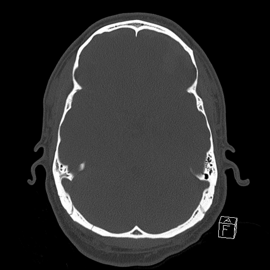 Bilateral occipital condyle fracture (type 2) (Radiopaedia 87675-104089 Axial bone window 47).jpg