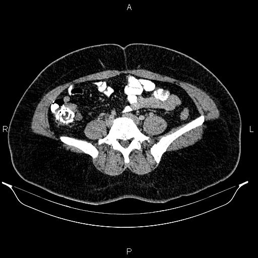 Bilateral ovarian dermoid cysts (Radiopaedia 85785-101603 A 72).jpg