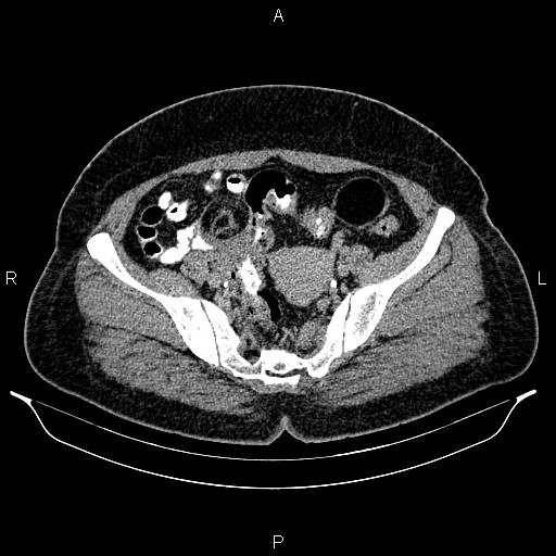 Bilateral ovarian dermoid cysts (Radiopaedia 85785-101603 Axial C+ delayed 65).jpg