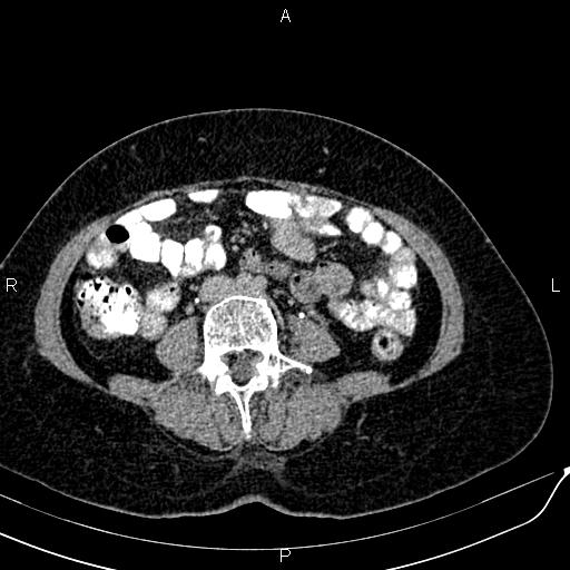 Bilateral ovarian serous cystadenocarcinoma (Radiopaedia 86062-101989 Axial C+ delayed 42).jpg
