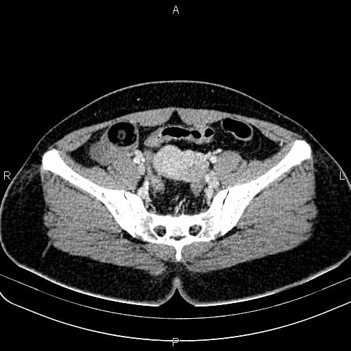 Bilateral ovarian teratoma (Radiopaedia 83131-97503 Axial With contrast 31).jpg