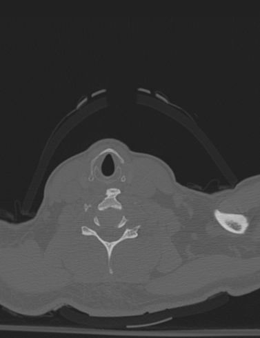 Bilateral perched facet joint (Radiopaedia 63149-71669 Axial bone window 48).jpg