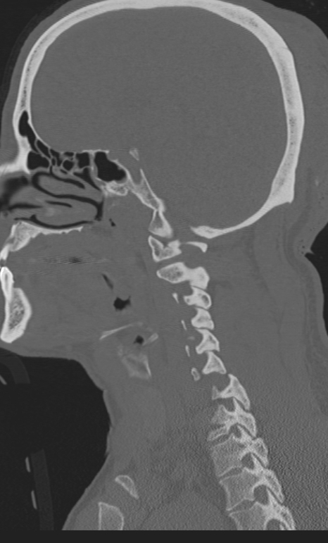 Bilateral perched facet joint (Radiopaedia 63149-71669 Sagittal bone window 11).jpg