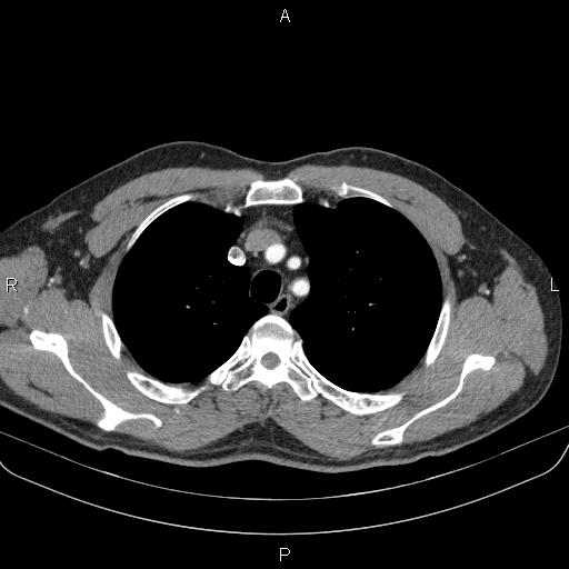 File:Bilateral pulmonary AVM (Radiopaedia 83134-97505 A 18).jpg