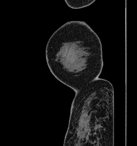 File:Bilateral rectus sheath hematomas (Radiopaedia 50778-56252 B 2).jpg