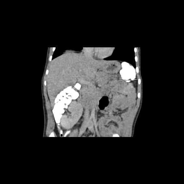 File:Bilateral renal malrotation (Radiopaedia 30901-31606 B 40).jpg