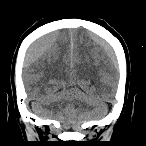Bilateral subacute subdural hematoma (Radiopaedia 69240-79018 Coronal non-contrast 42).jpg