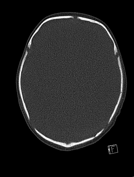 Bilateral subdural hemorrhage and parietal skull fracture (Radiopaedia 26058-26192 Axial bone window 78).png