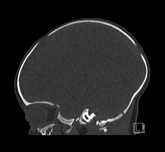 Bilateral subdural hemorrhage and parietal skull fracture (Radiopaedia 26058-26192 Sagittal bone window 33).png