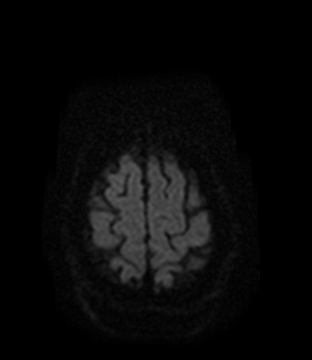 File:Bilateral thalamic glioma (Radiopaedia 65852-75009 Axial DWI 19).jpg