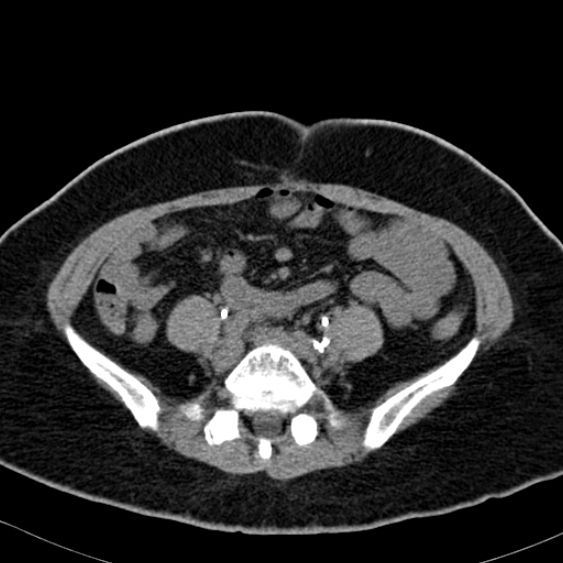 Bilateral ureteric stents (Radiopaedia 48795-53825 Axial non-contrast 41).jpg