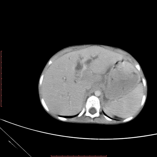 Biliary tract embryonal rhabdomyosarcoma (Radiopaedia 51815-57648 A 19).jpg