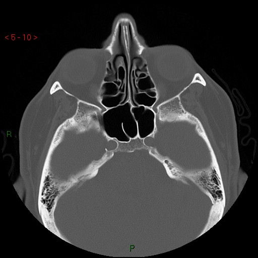 Bisphosphonate-related osteonecrosis of the jaw (Radiopaedia 54147-60329 Axial bone window 4).jpg
