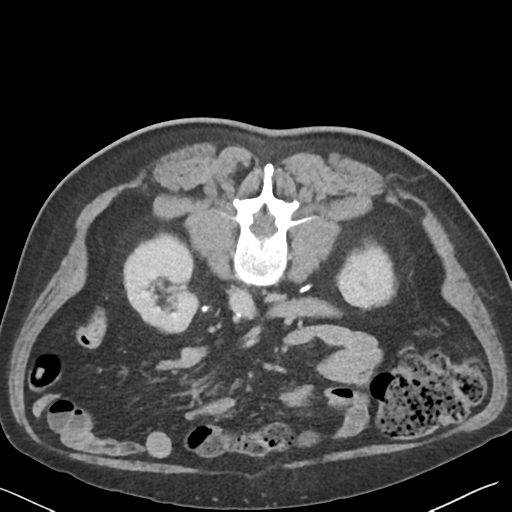 File:Bladder papillary urothelial carcinoma (Radiopaedia 48119-52951 Axial C+ delayed 24).png