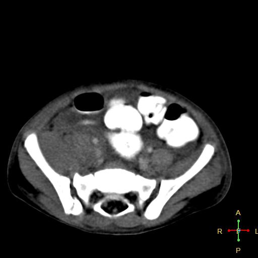 Blunt abdominal trauma (Radiopaedia 24780-25044 B 37).jpg
