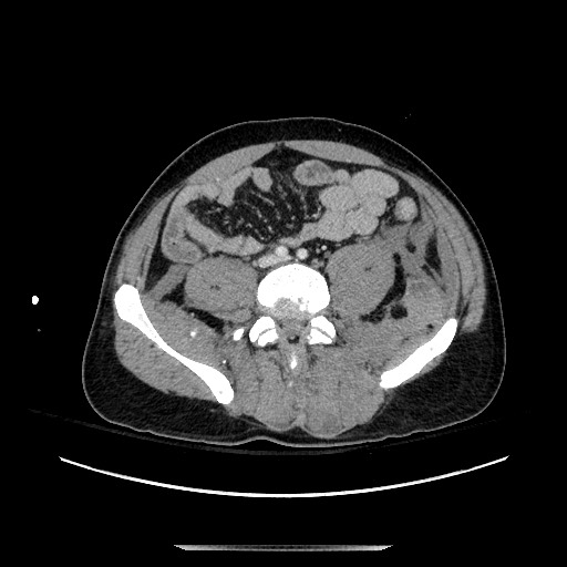 Blunt abdominal trauma with solid organ and musculoskelatal injury with active extravasation (Radiopaedia 68364-77895 A 103).jpg
