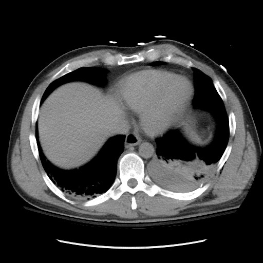 Blunt abdominal trauma with solid organ and musculoskelatal injury with active extravasation (Radiopaedia 68364-77895 Axial C+ delayed 15).jpg