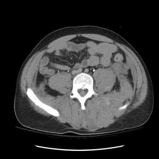 Blunt abdominal trauma with solid organ and musculoskelatal injury with active extravasation (Radiopaedia 68364-77895 Axial C+ delayed 89).jpg