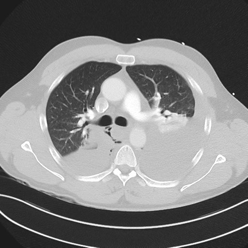 Boerhaave syndrome (Radiopaedia 39382-41660 Axial lung window 21).png