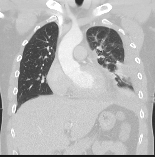 Boerhaave syndrome (Radiopaedia 39382-41661 Coronal lung window 19).png