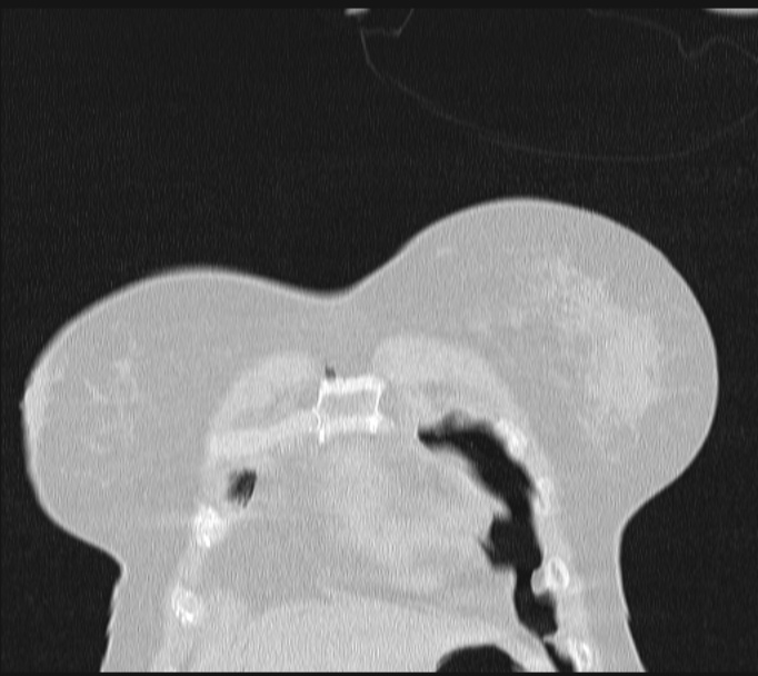 Boerhaave syndrome (Radiopaedia 45644-49799 Coronal lung window 8).jpg