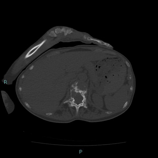 Bone metastases from untreated breast cancer (Radiopaedia 42973-46219 Axial bone window 97).jpg