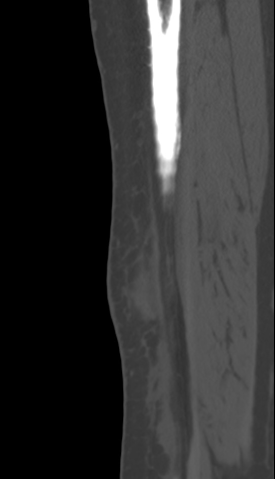 Bone metastasis - tibia (Radiopaedia 57665-64609 Sagittal bone window 34).jpg