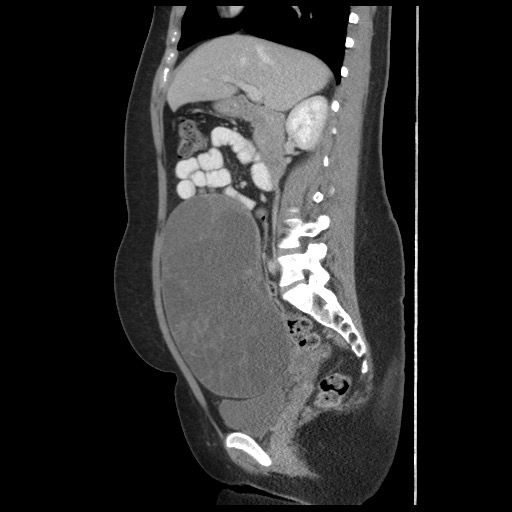 File:Borderline mucinous tumor (ovary) (Radiopaedia 78228-90808 B 30).jpg