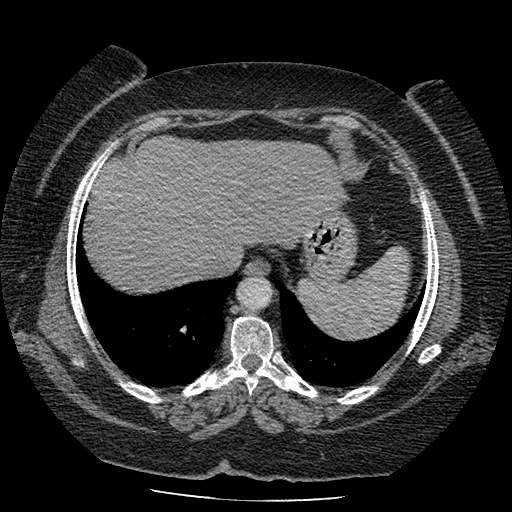 Bovine aortic arch - right internal mammary vein drains into the superior vena cava (Radiopaedia 63296-71875 A 135).jpg