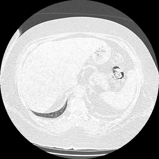 Bovine aortic arch - right internal mammary vein drains into the superior vena cava (Radiopaedia 63296-71875 Axial lung window 175).jpg