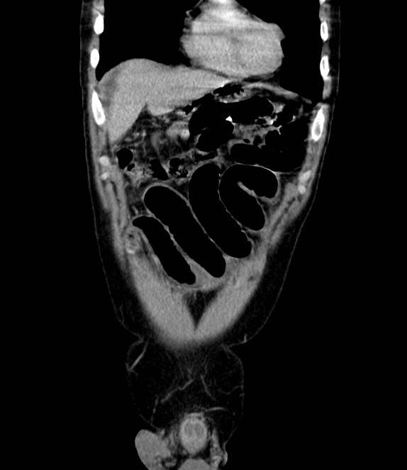 Bowel obstruction from colon carcinoma (Radiopaedia 22995-23028 C 13).jpg