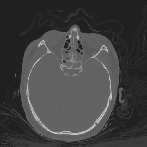 File:Brain contusions, internal carotid artery dissection and base of skull fracture (Radiopaedia 34089-35339 Axial bone window 65).png