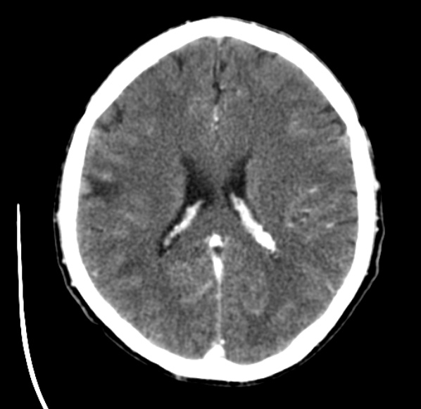 File:Brain metastases from lung cancer (Radiopaedia 24480-24781 Axial C+ delayed 37).jpg