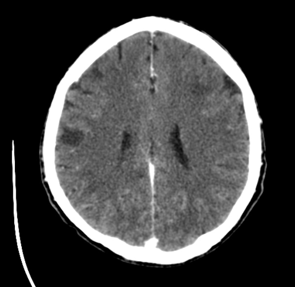 File:Brain metastases from lung cancer (Radiopaedia 24480-24781 Axial C+ delayed 40).jpg