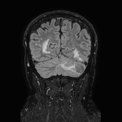 Brain metastases from lung cancer (Radiopaedia 83839-99028 Coronal FLAIR 63).jpg
