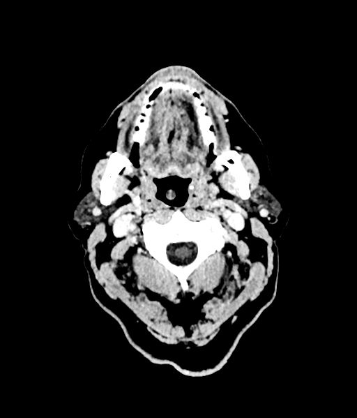 Brain metastasis (large cystic mass) (Radiopaedia 47497-52106 Axial C+ 2).png