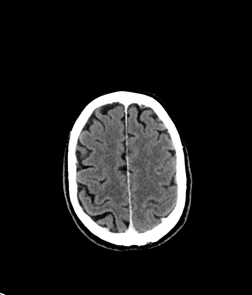 Brain metastasis (large cystic mass) (Radiopaedia 47497-52106 Axial C+ 47).png