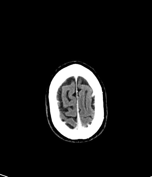 Brain metastasis (large cystic mass) (Radiopaedia 47497-52106 Axial C+ 52).png