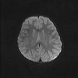 Brainstem glioma (Radiopaedia 67531-76922 Axial DWI 39).jpg