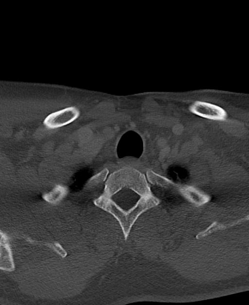 Branchial cleft cyst (Radiopaedia 31167-31875 Axial bone window 67).jpg