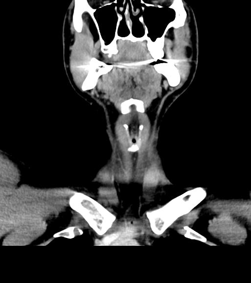 Branchial cleft cyst (Radiopaedia 31167-31875 Coronal C+ delayed 22).jpg
